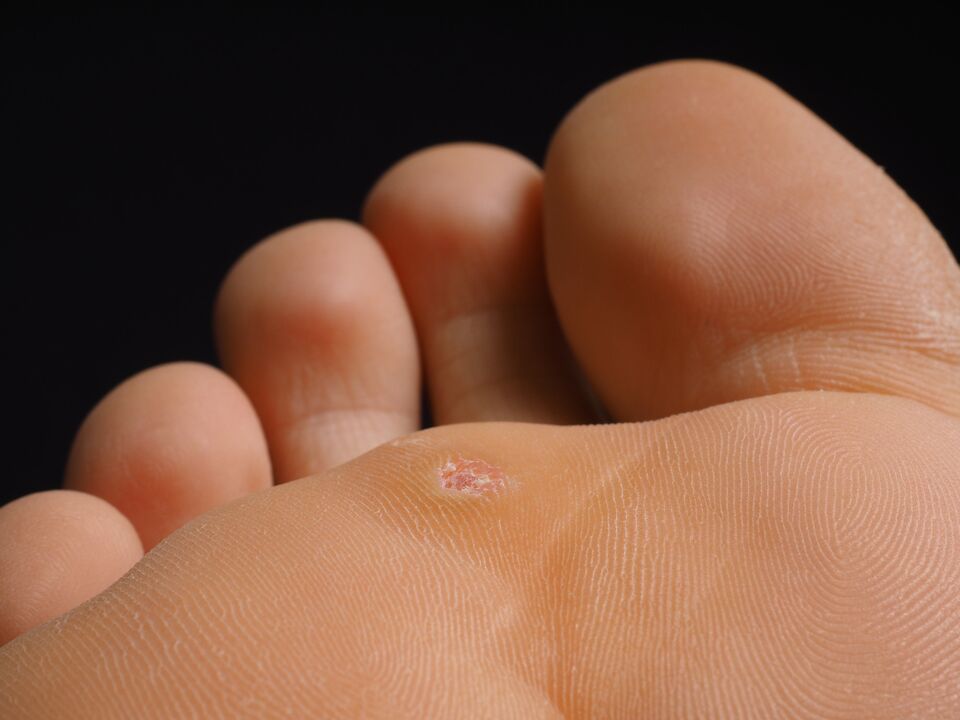 to look like a plantar wart