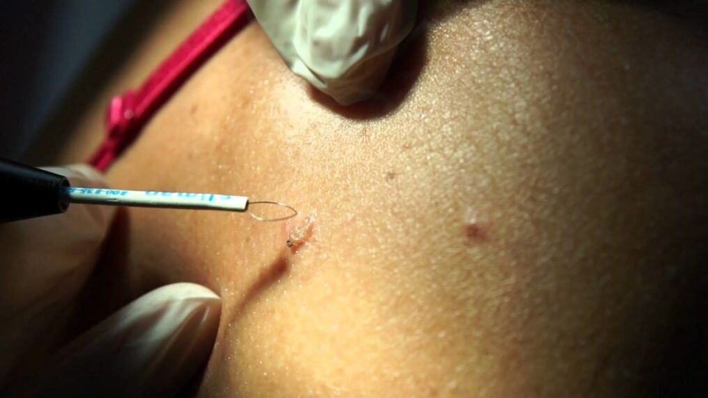 radio wave removal of the papilloma