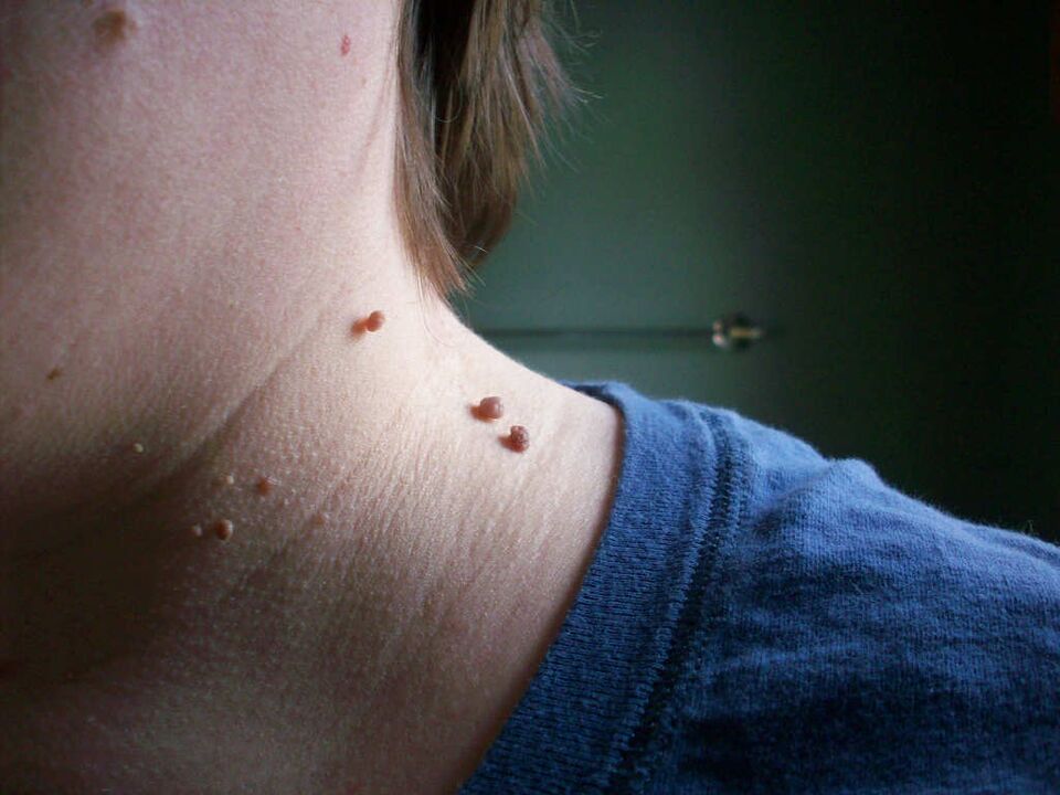papillomas on the neck, how to treat them