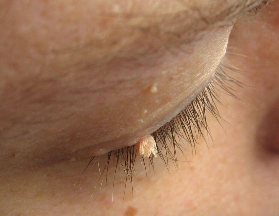 papillomas on the eyelids