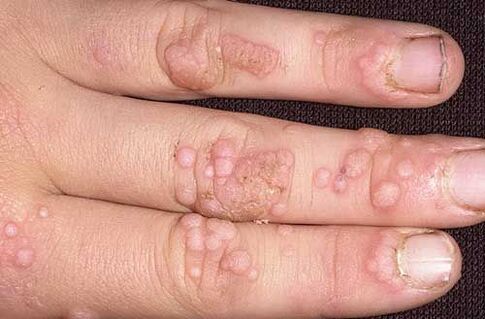 how to get rid of hand warts